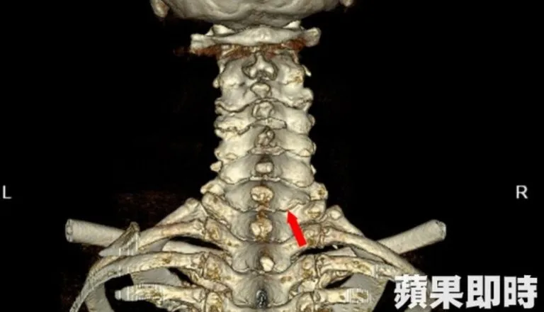 頸椎內視鏡手術成功，解決林阿姨長年劇痛