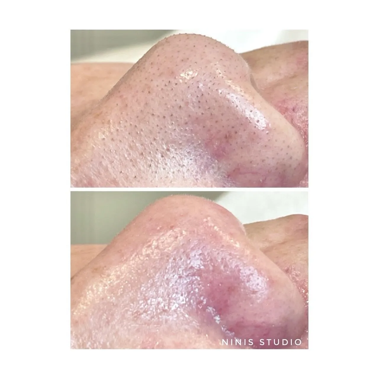 前後對比分享｜代謝粉刺保養｜板橋清痘痘