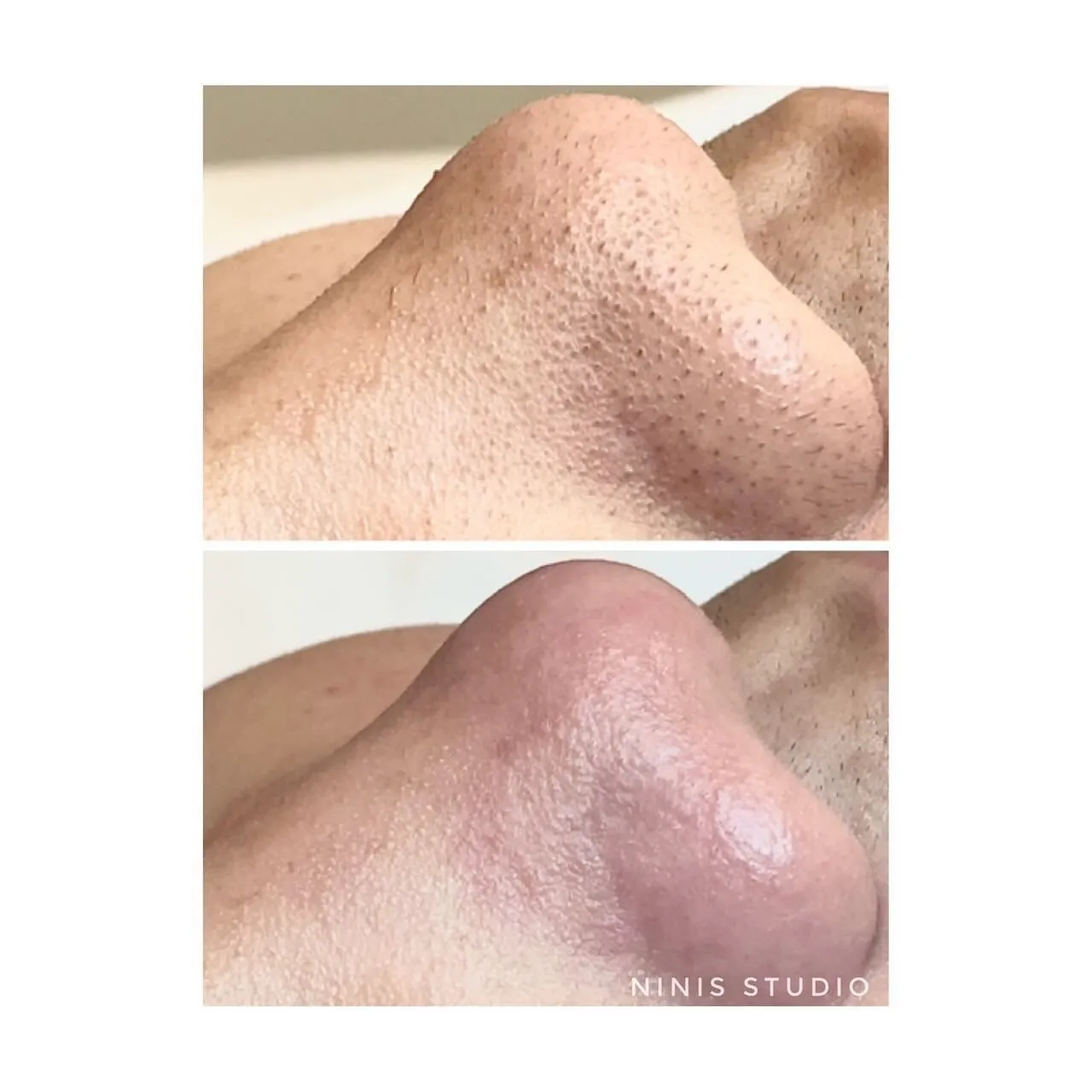 前後對比分享｜代謝粉刺保養｜板橋清痘痘