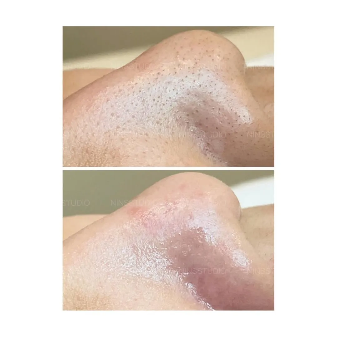 前後對比分享｜代謝粉刺保養｜板橋清痘痘