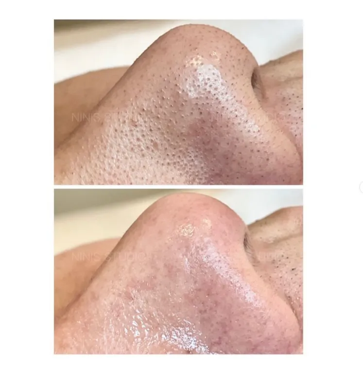 前後對比分享｜毛孔淨化療程｜板橋做臉