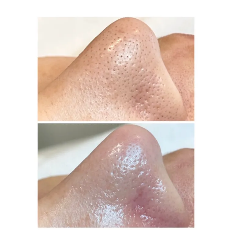 前後對比分享｜毛孔淨化療程｜板橋做臉