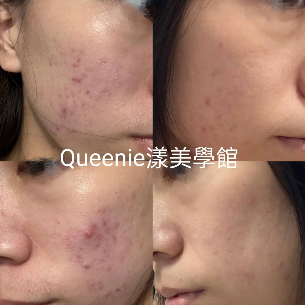 【臉部案例分享｜粉刺痘痘改善紀錄】
