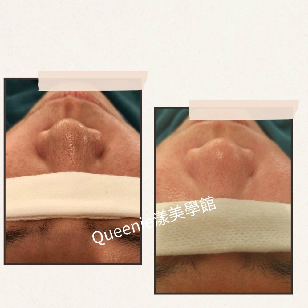 【案例分享｜忙碌媽媽的黑頭煩惱】