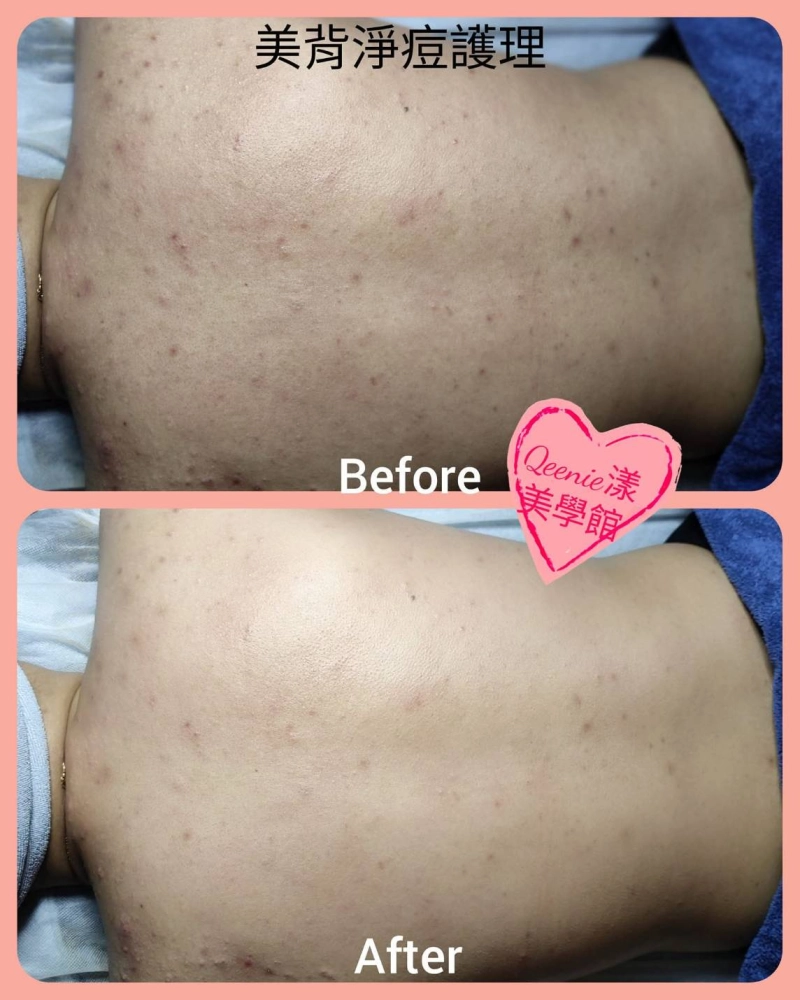 【背部痘痘案例分享｜從不敢露背」到「自信穿出美】