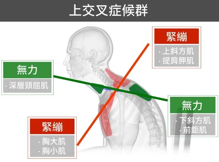 上交叉症候群 之定義、原因、症狀、建議、治療