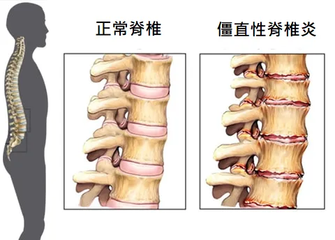 僵直性脊椎炎 之定義、原因、症狀、建議、治療