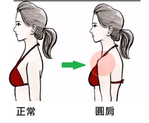 圓肩 之定義、原因、症狀、建議、治療