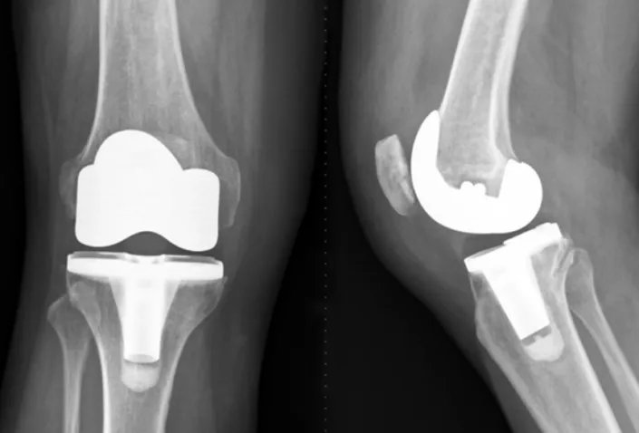 人工膝關節置換 之併發症 後遺症 建議與治療 – 松山景能物理治療所