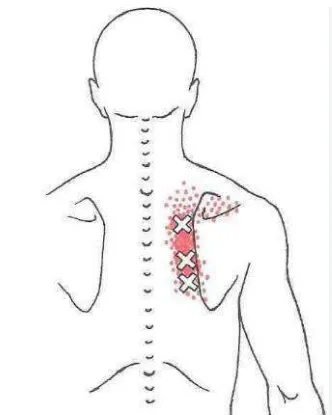 膏肓痛 之定義、原因、症狀、建議、治療 – 松山景能物理治療所