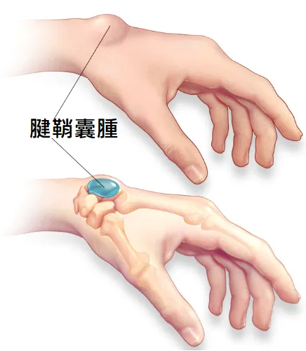 腱鞘囊腫 之定義、原因、症狀、建議、治療 – 松山景能物理治療所