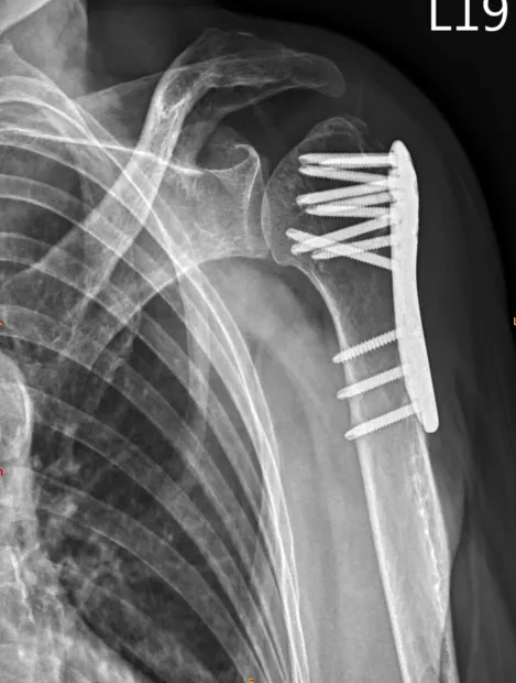 肱骨骨折 之併發症 後遺症 建議與治療 – 松山景能物理治療所