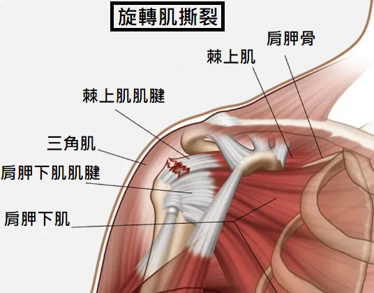 肩旋轉肌破洞撕裂 之併發症 後遺症 建議與治療 – 松山景能物理治療所