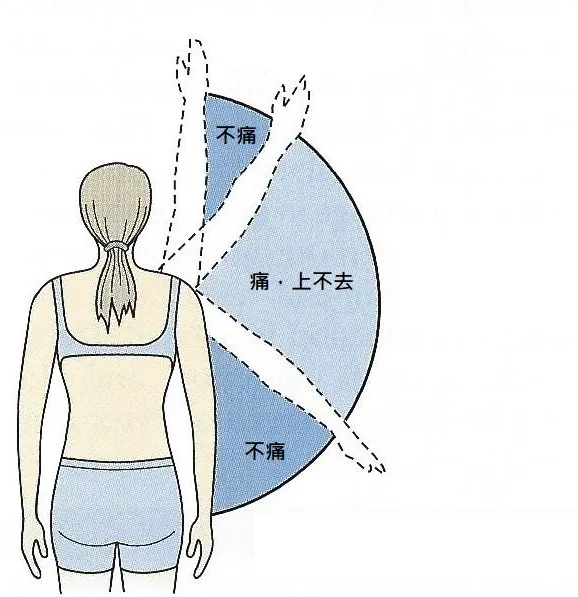 肩夾擠症候群 之定義、原因、症狀、建議、治療 – 松山景能物理治療所