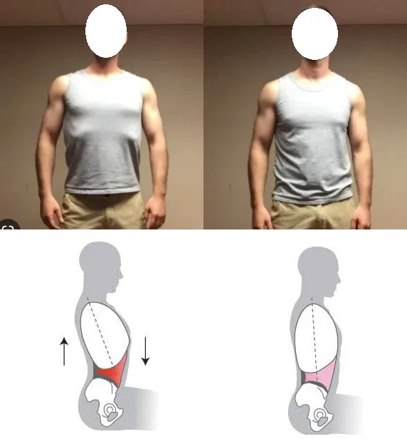 肋骨外翻 之定義、原因、症狀、建議、治療 – 松山景能物理治療所