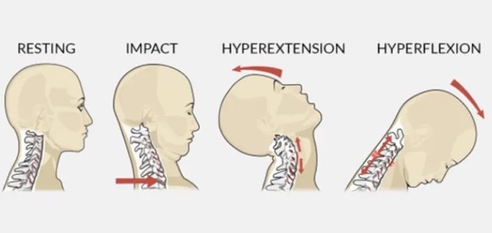 揮鞭症候群 之定義、原因、症狀、建議、治療 – 松山景能物理治療所