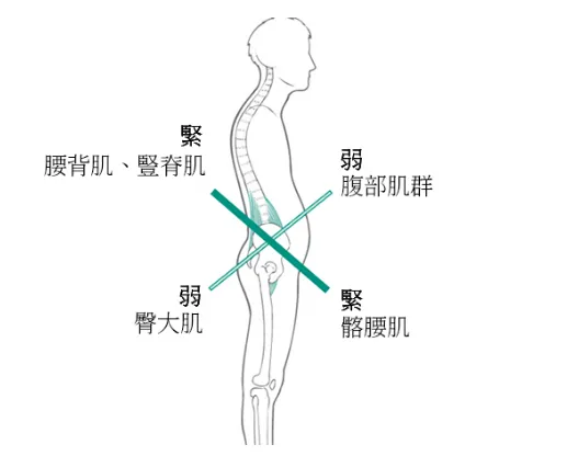 下交叉症候群 之定義、原因、症狀、建議、治療 – 松山景能物理治療所