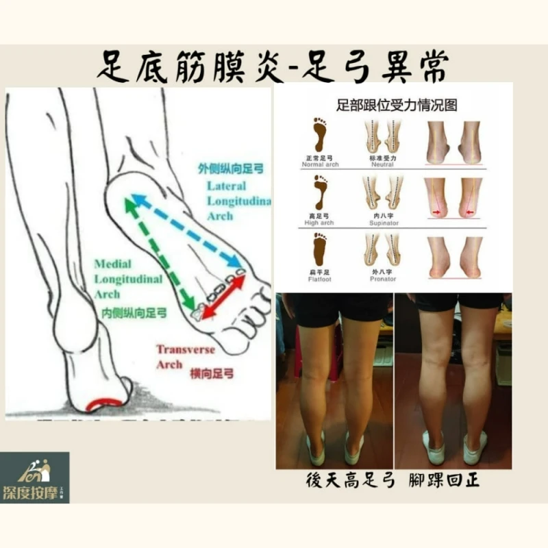 足弓對足底筋膜炎的影響 | Ren 深度按摩工作室  | 新竹運動按摩