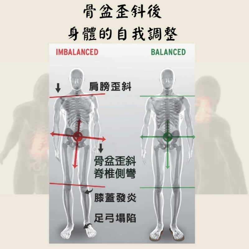 下交叉綜合症-骨盆歪斜 | Ren 深度按摩工作室 | 新竹運動按摩