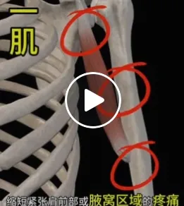 喙肱肌/高雄筋膜刀/高雄筋膜刀放鬆