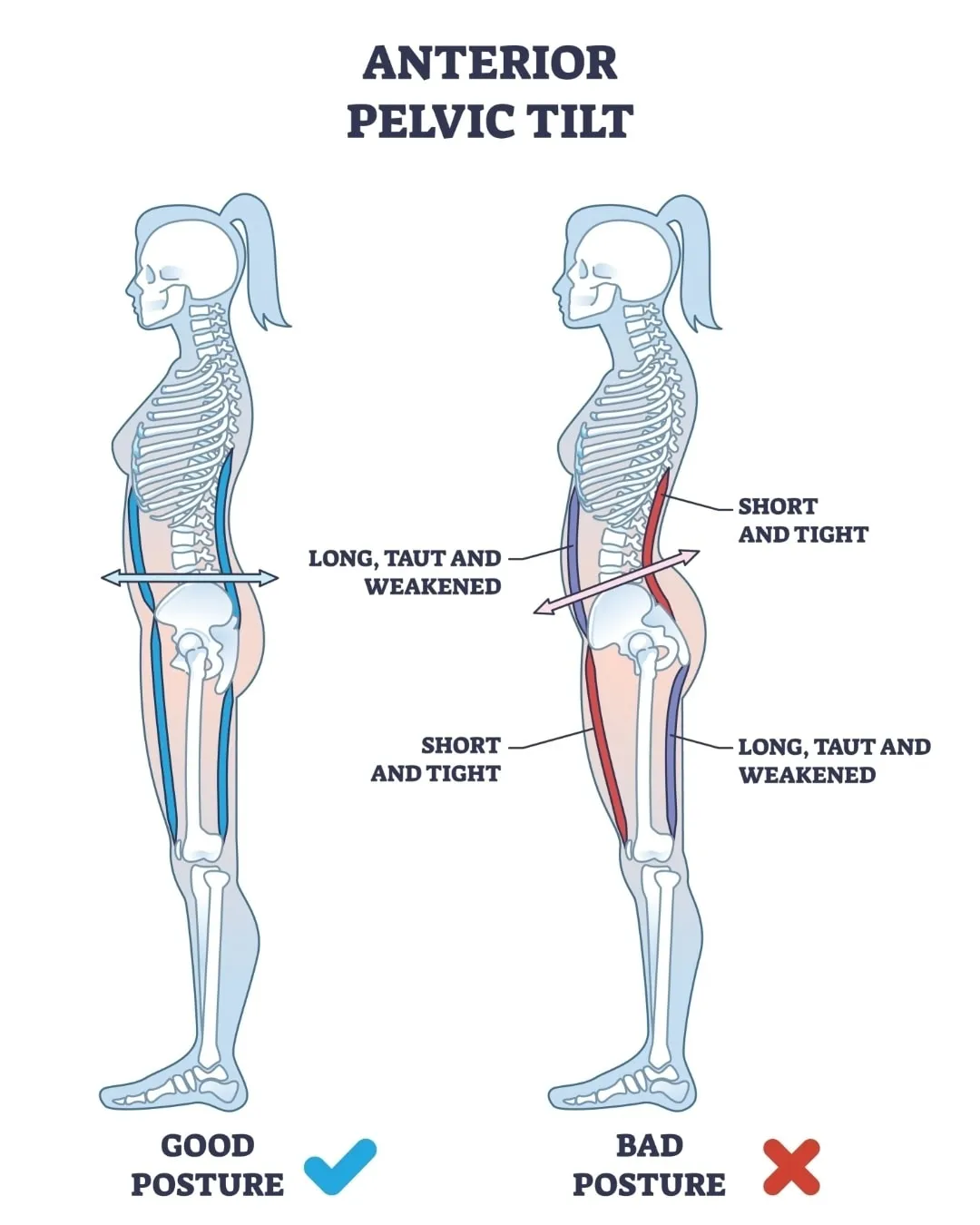 深蹲時後腿有拉扯感，竟然要處理「前側」？高雄筋膜刀按摩/高雄筋膜調理