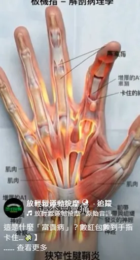 這是什麼「富貴病」？數紅包數到手指卡住...【運動按摩推薦】【台中運動按摩】