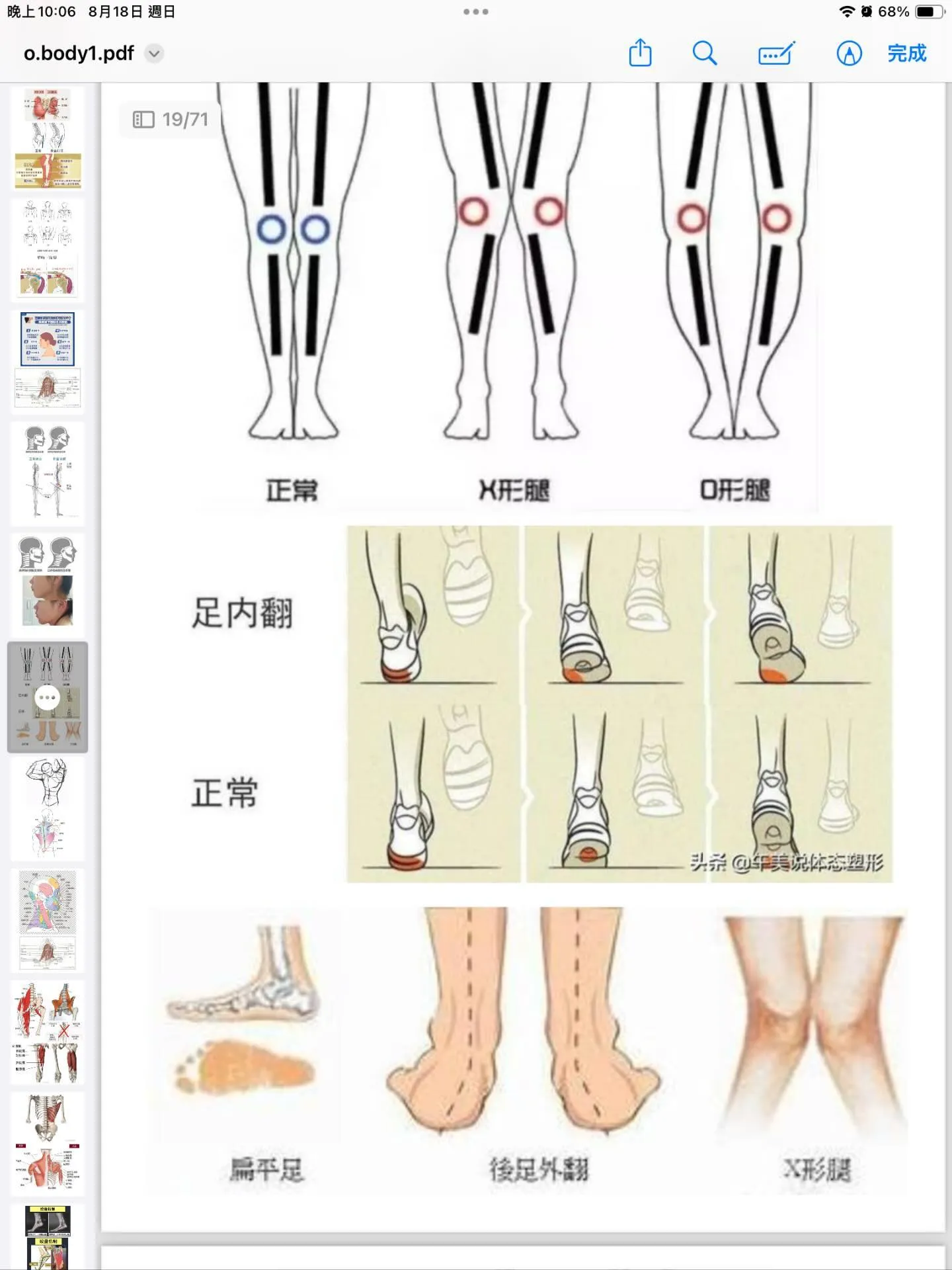 「X型腿」好困擾，好想找回筆直大長腿！/XO型腿推拿,雲林XO型腿推拿