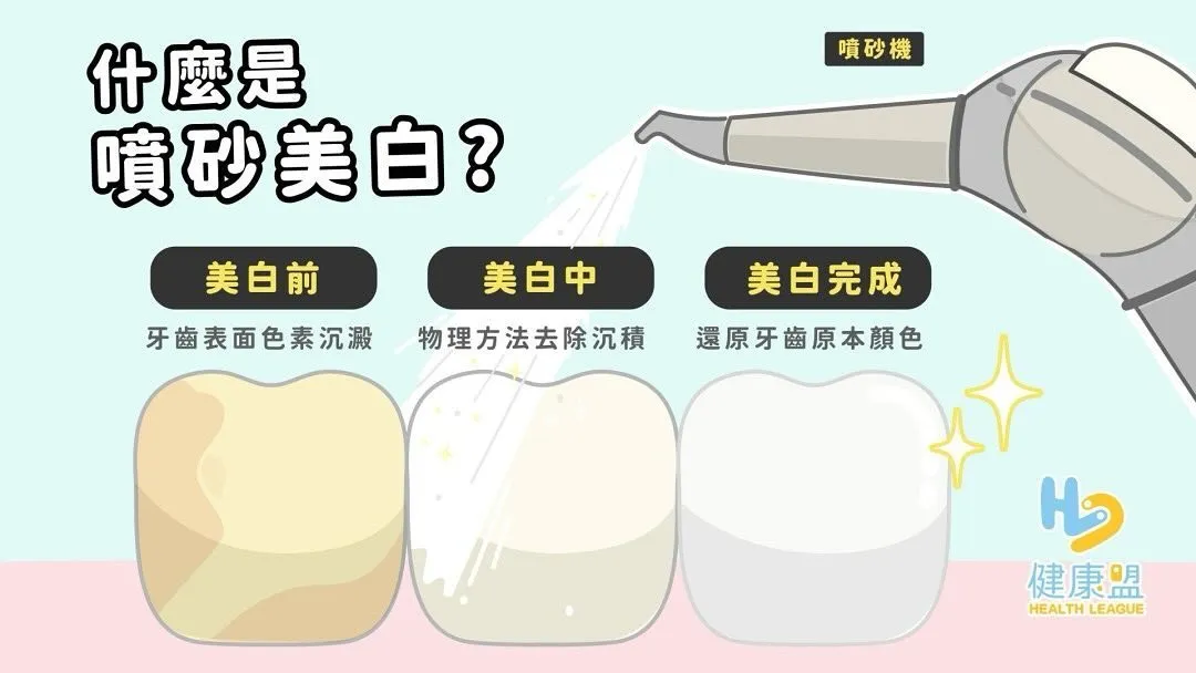 什麼是噴砂美白？ 也能讓牙齒變亮白嗎？