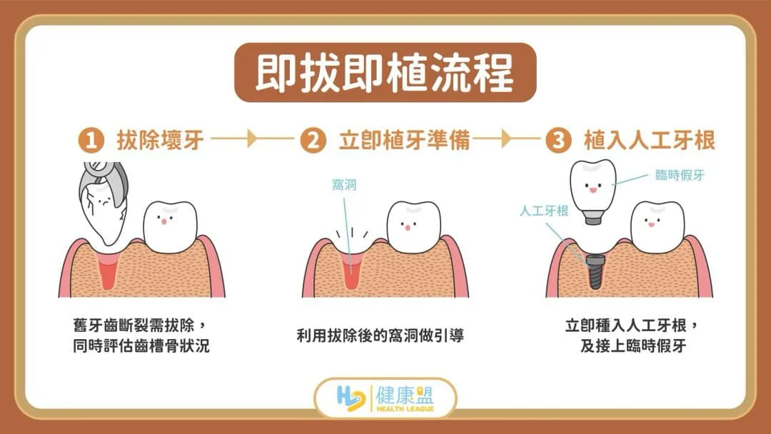什麼是即拔即植呢？ 跟一般植牙有什麼不同？