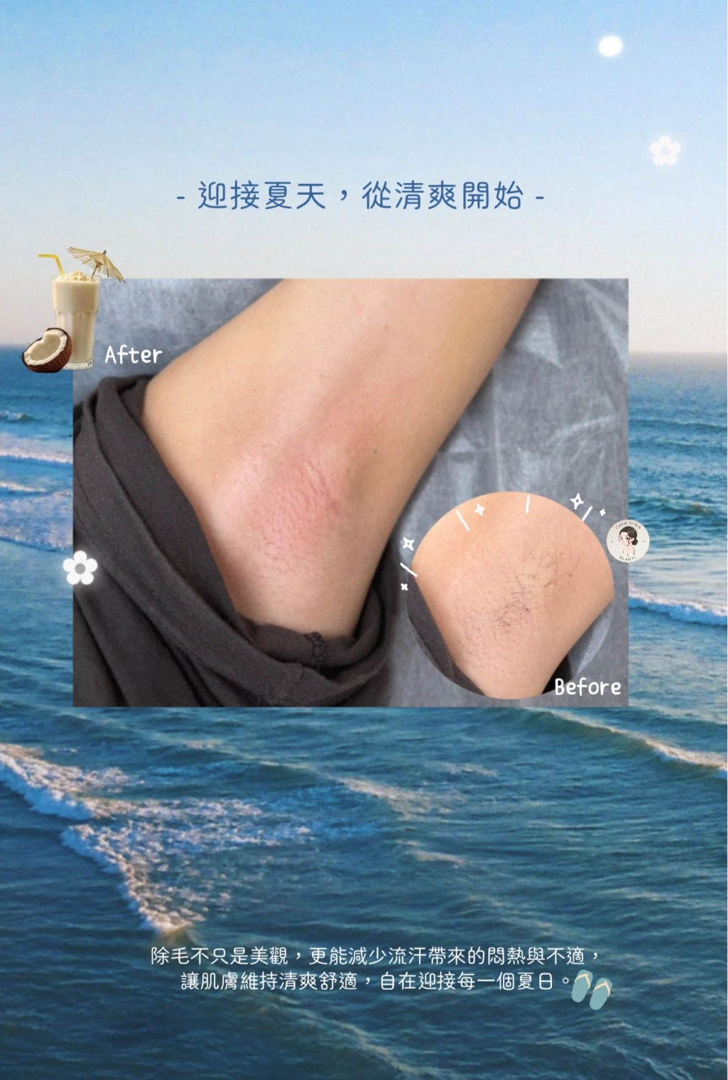 中山區腋下除毛推薦｜告別毛躁與悶熱感
