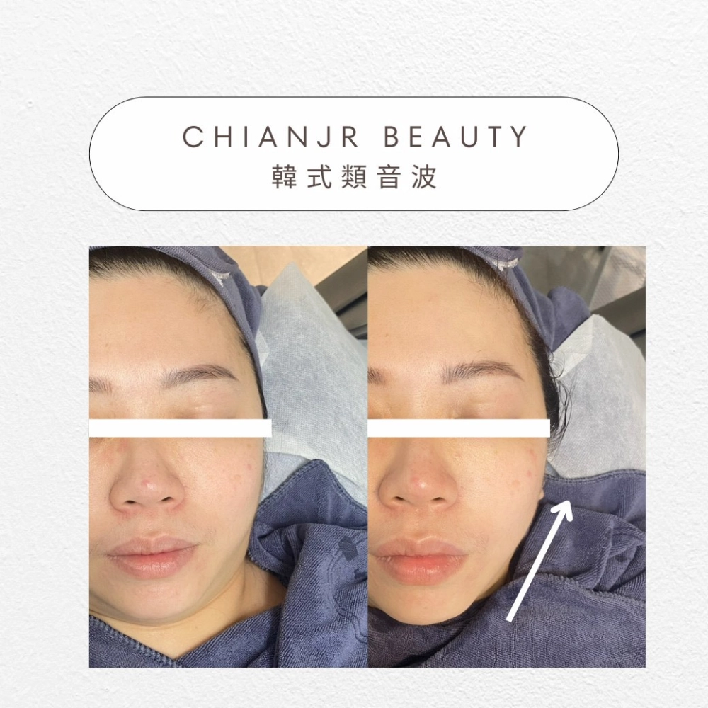 韓式小顏音波｜彰化韓式類音波｜和美韓式類音波
