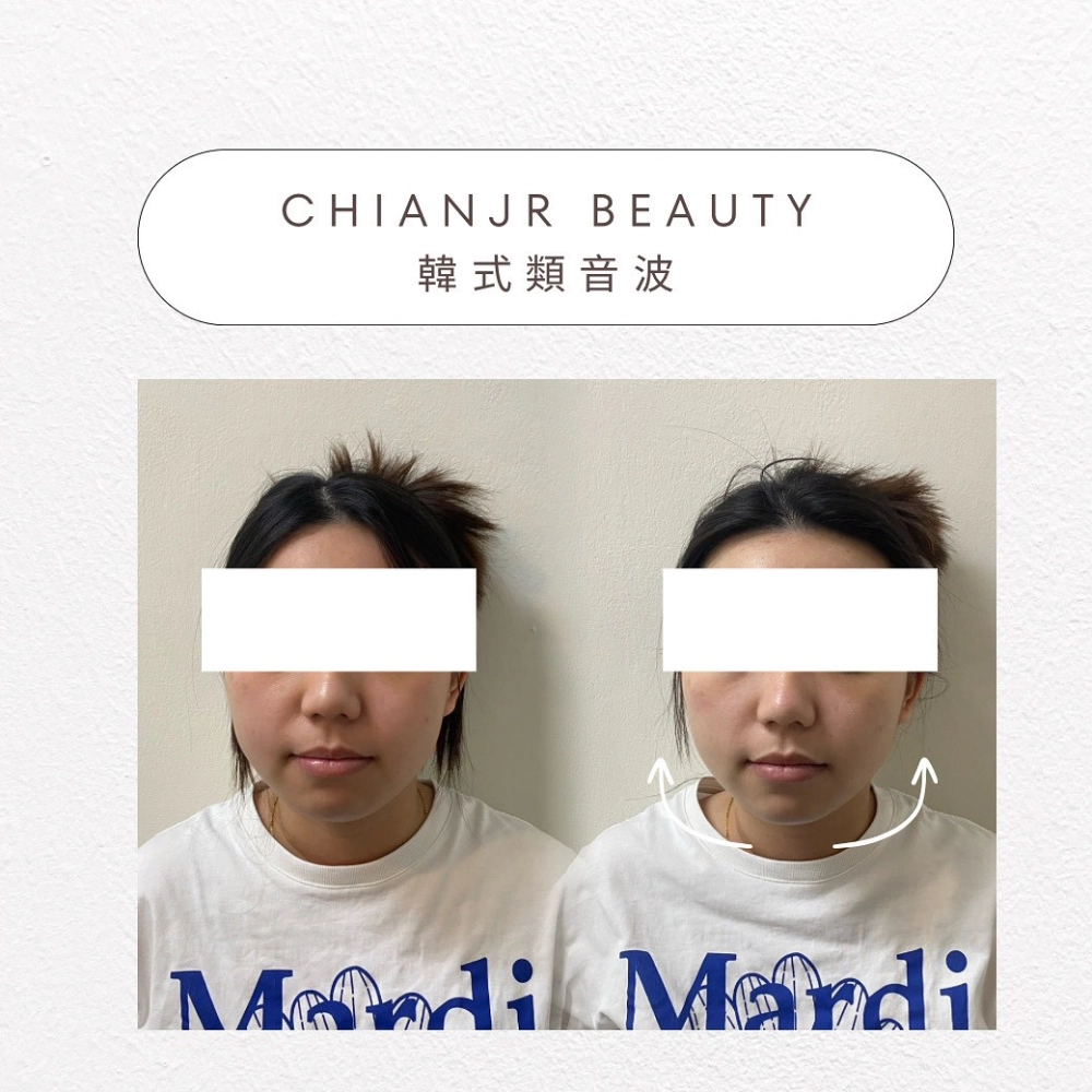 韓式小顏音波｜彰化韓式類音波｜和美韓式類音波