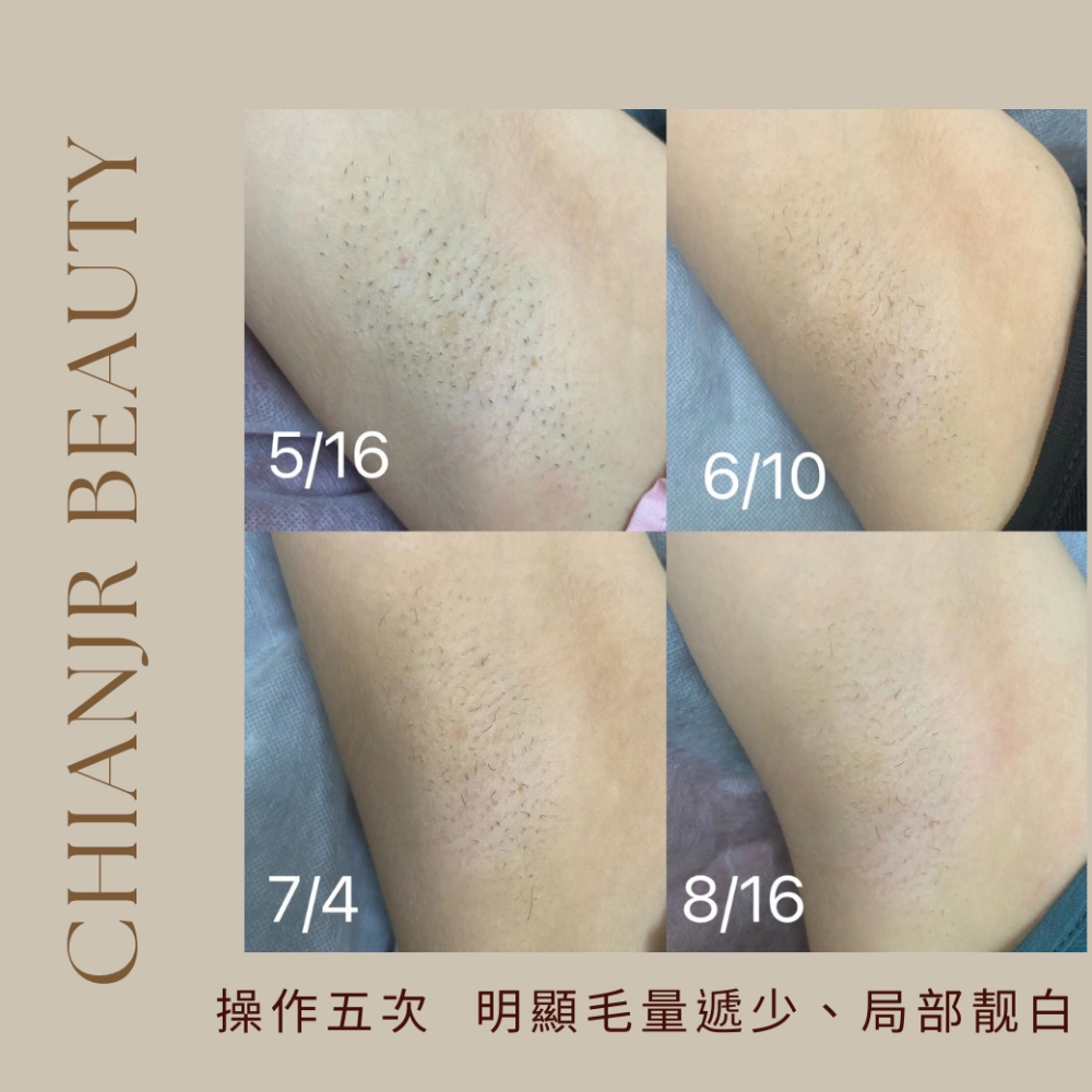 熱蠟 / 日式除毛｜彰化除毛｜和美除毛