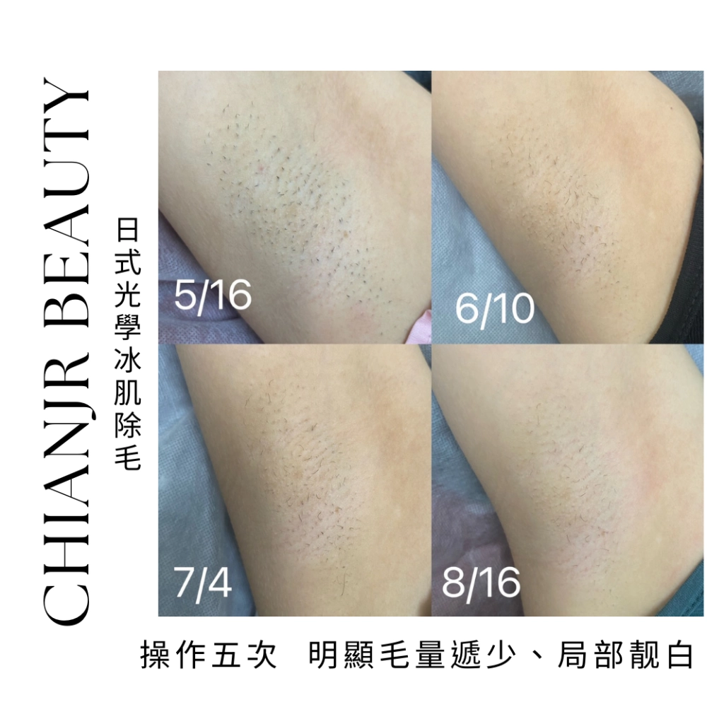 熱蠟 / 日式除毛｜彰化除毛｜和美除毛