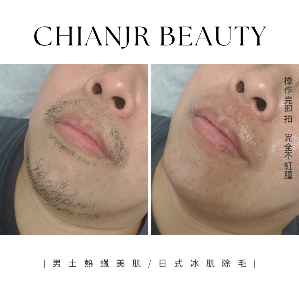 熱蠟 / 日式除毛｜彰化除毛｜和美除毛