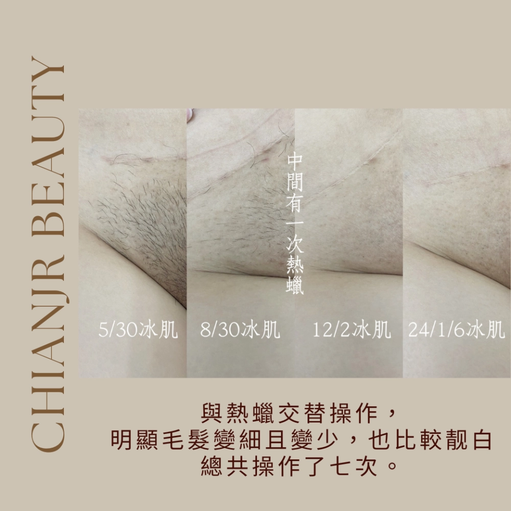 熱蠟 / 日式除毛｜彰化除毛｜和美除毛