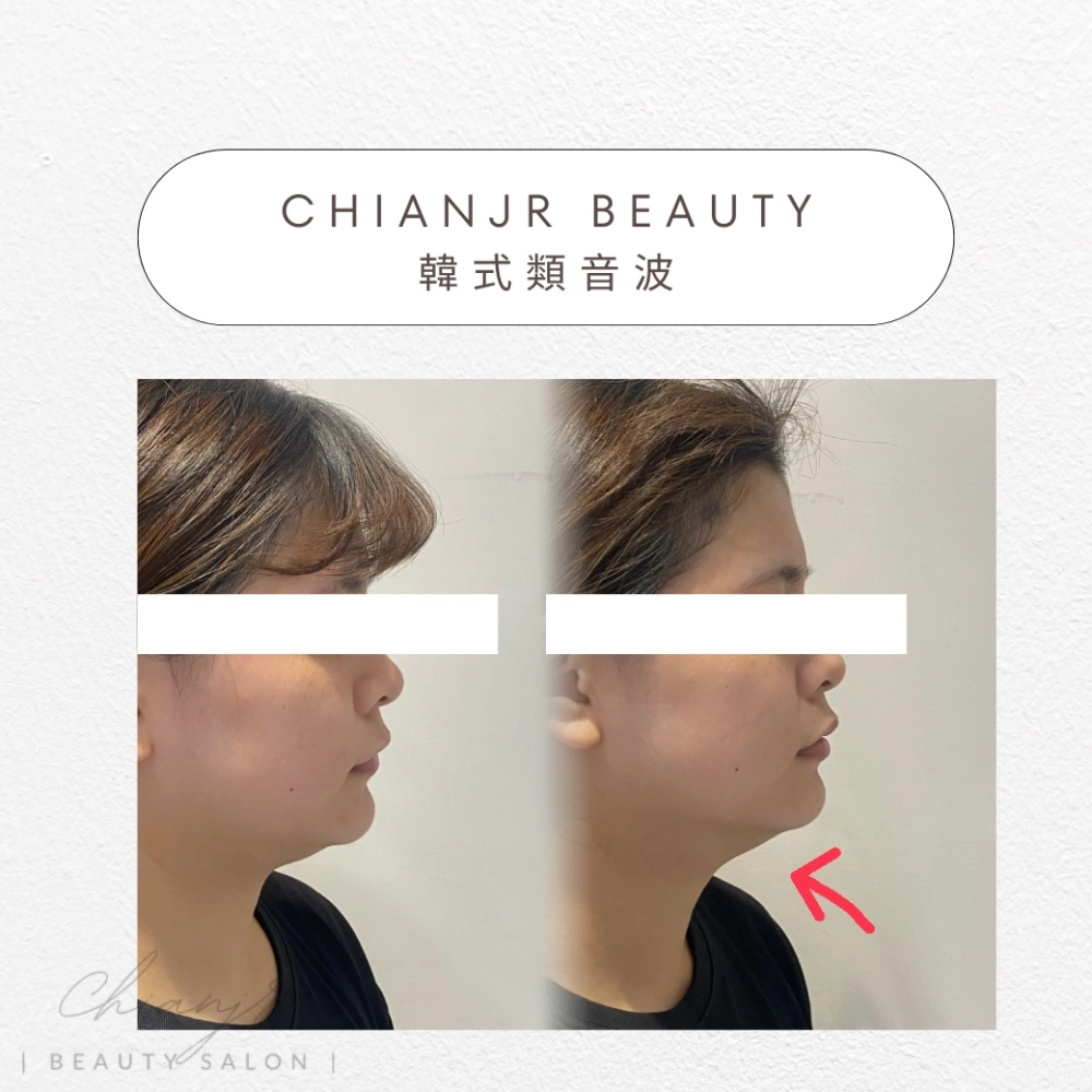 韓式小顏音波｜彰化韓式類音波｜和美韓式類音波