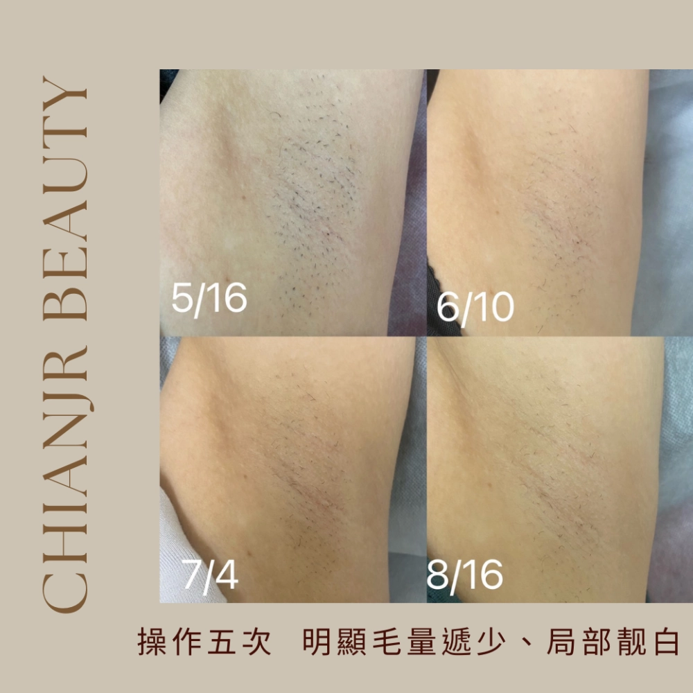 熱蠟 / 日式除毛｜彰化除毛｜和美除毛