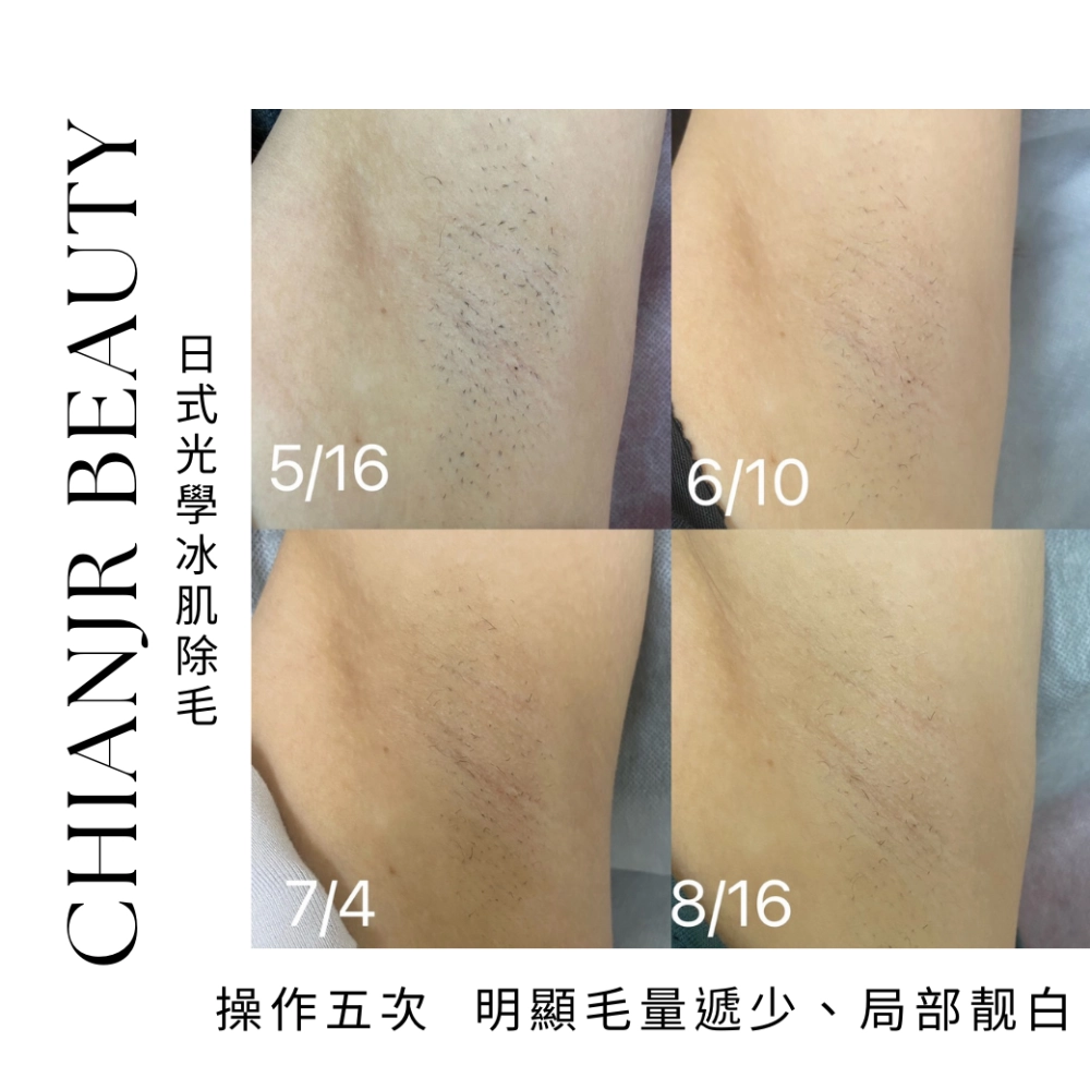 熱蠟 / 日式除毛｜彰化除毛｜和美除毛