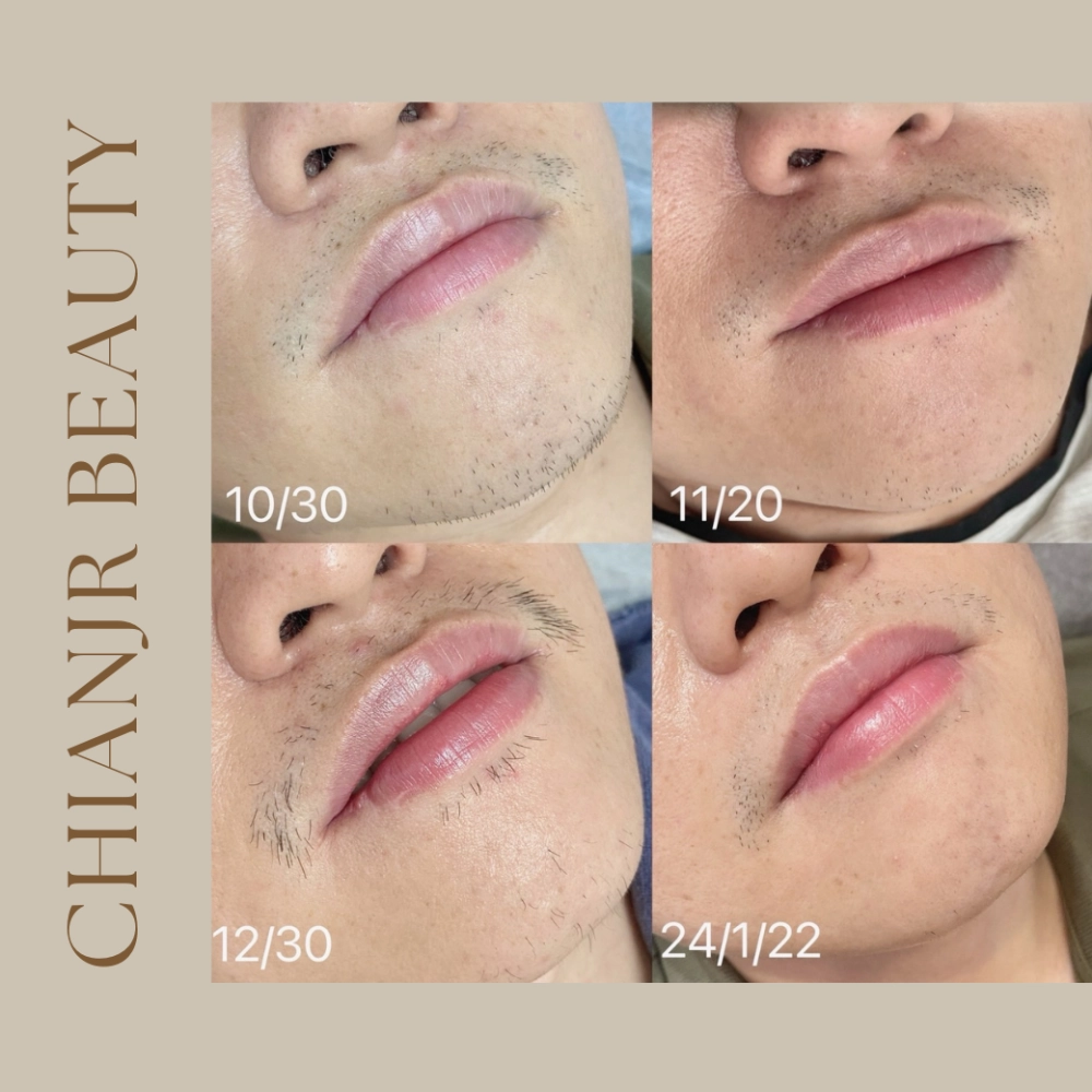 熱蠟 / 日式除毛｜彰化除毛｜和美除毛