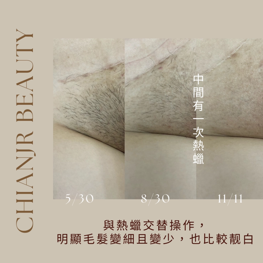 熱蠟 / 日式除毛｜彰化除毛｜和美除毛