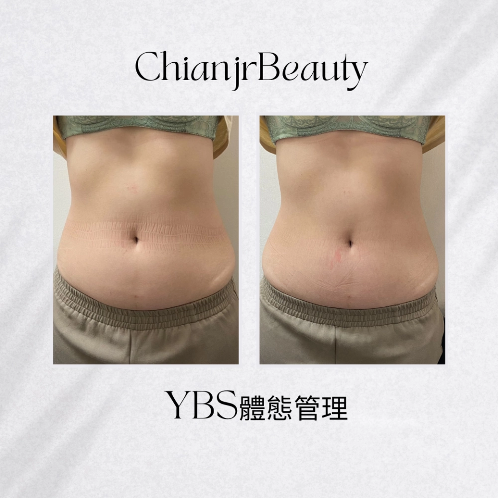 YBS體態管理｜彰化產後腹直肌修復｜和美產後修復