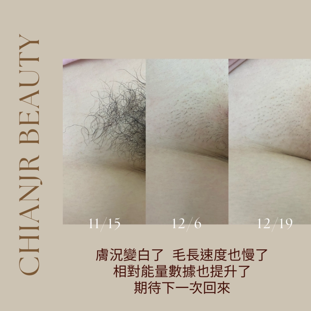 熱蠟 / 日式除毛｜彰化除毛｜和美除毛