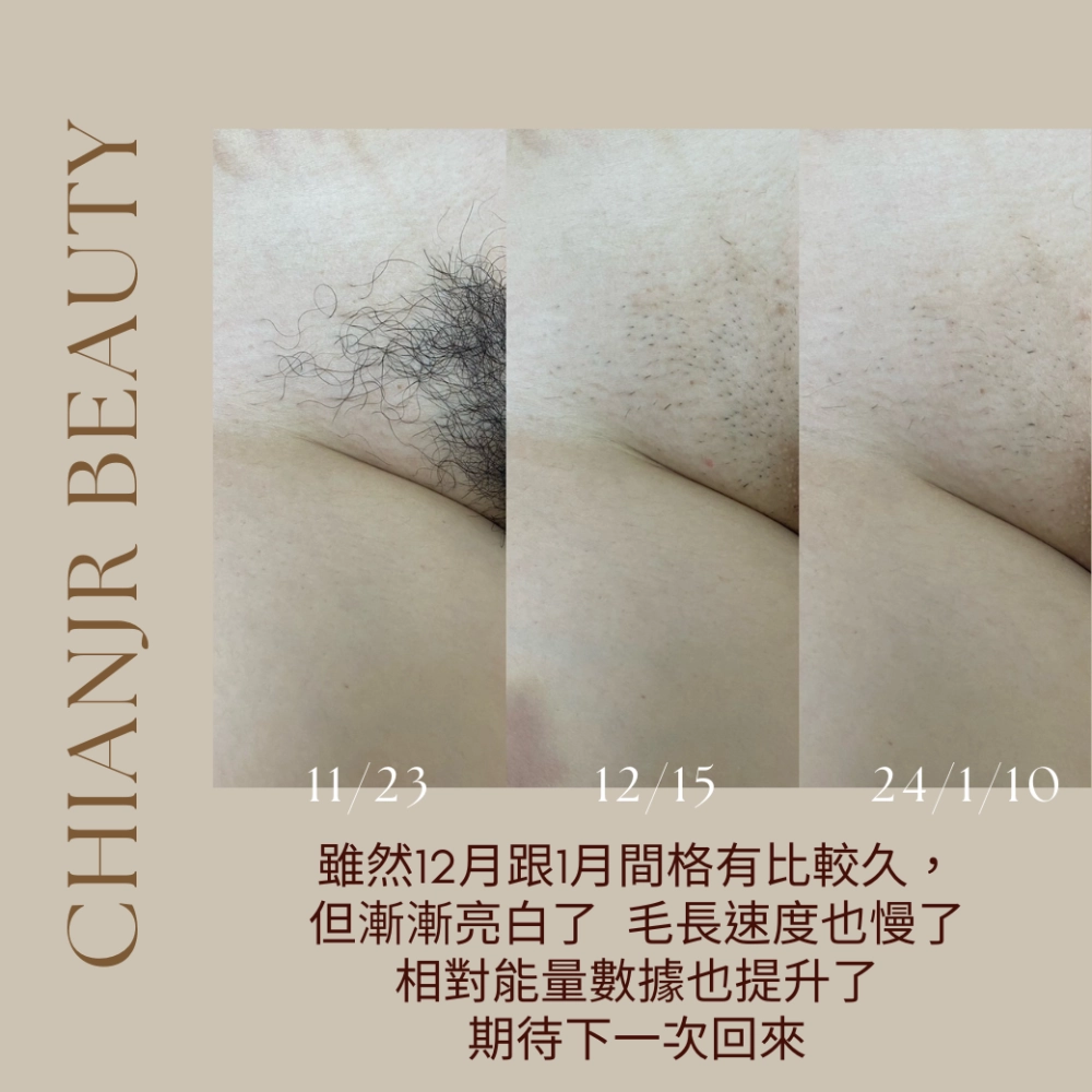 熱蠟 / 日式除毛｜彰化除毛｜和美除毛