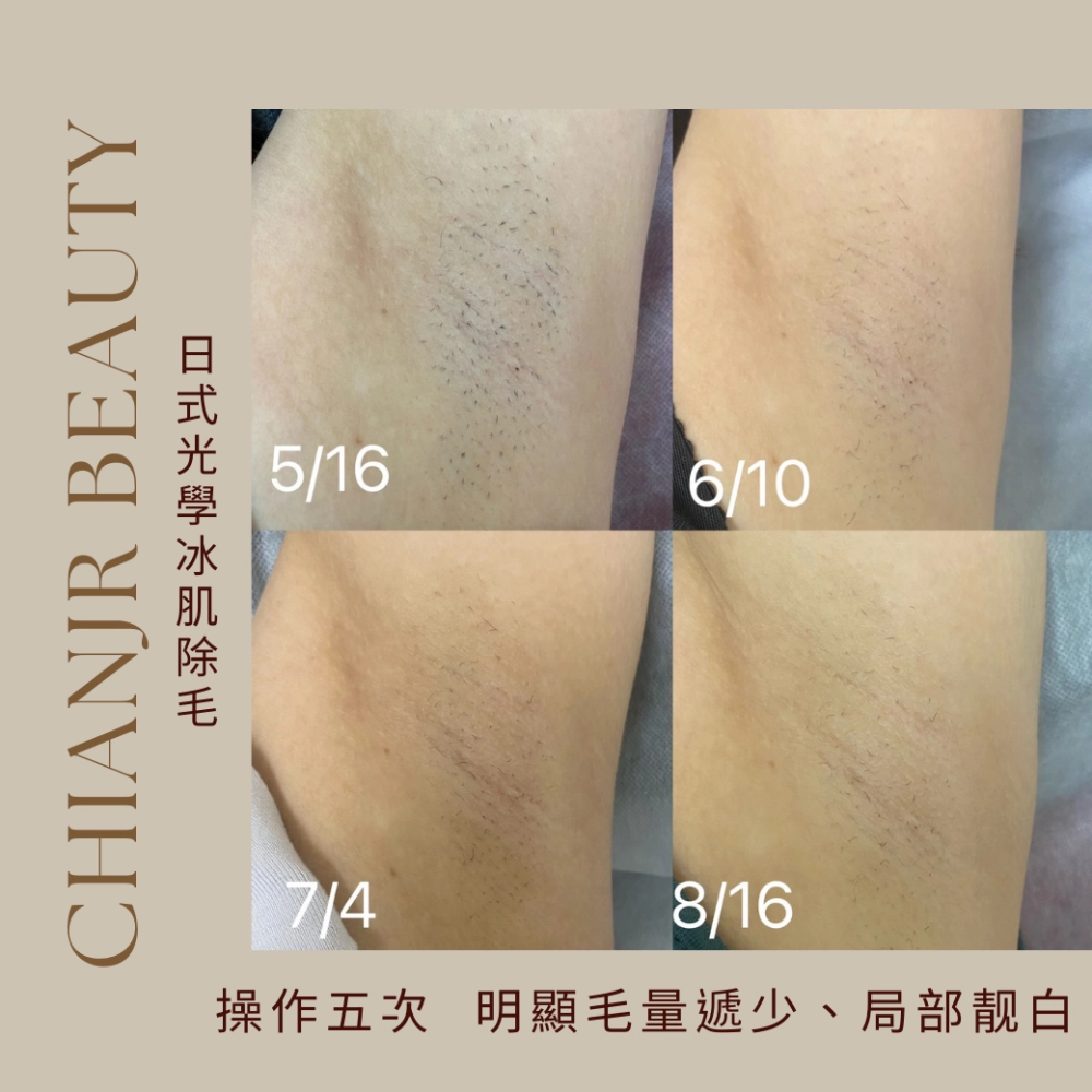 熱蠟 / 日式除毛｜彰化除毛｜和美除毛