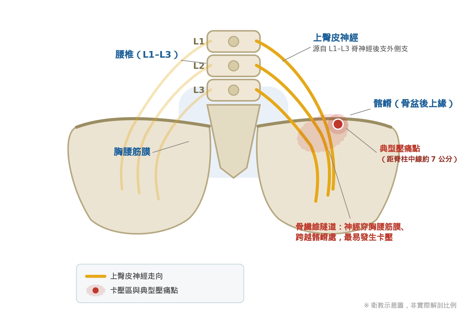 影像找不到原因的腰痛、屁股痛？上臀皮神經卡壓的超音波導引針刀治療｜台中海線