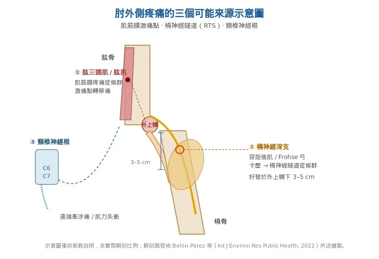 治不好的網球肘真相：摸不到痛點，問題可能在肌筋膜、橈神經與頸椎