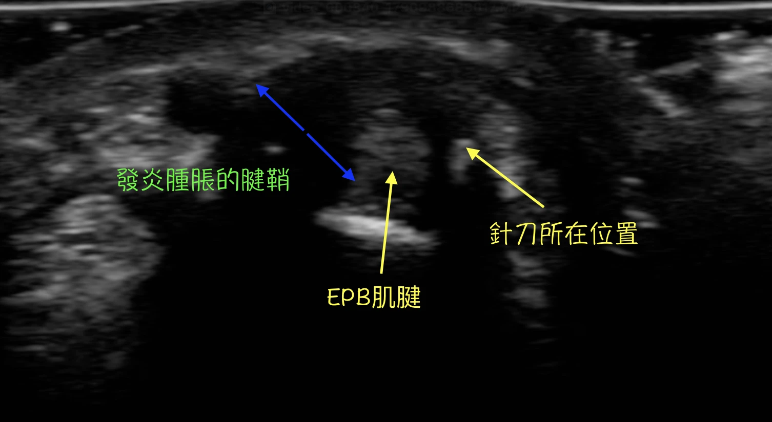 本案例超音波短軸影像