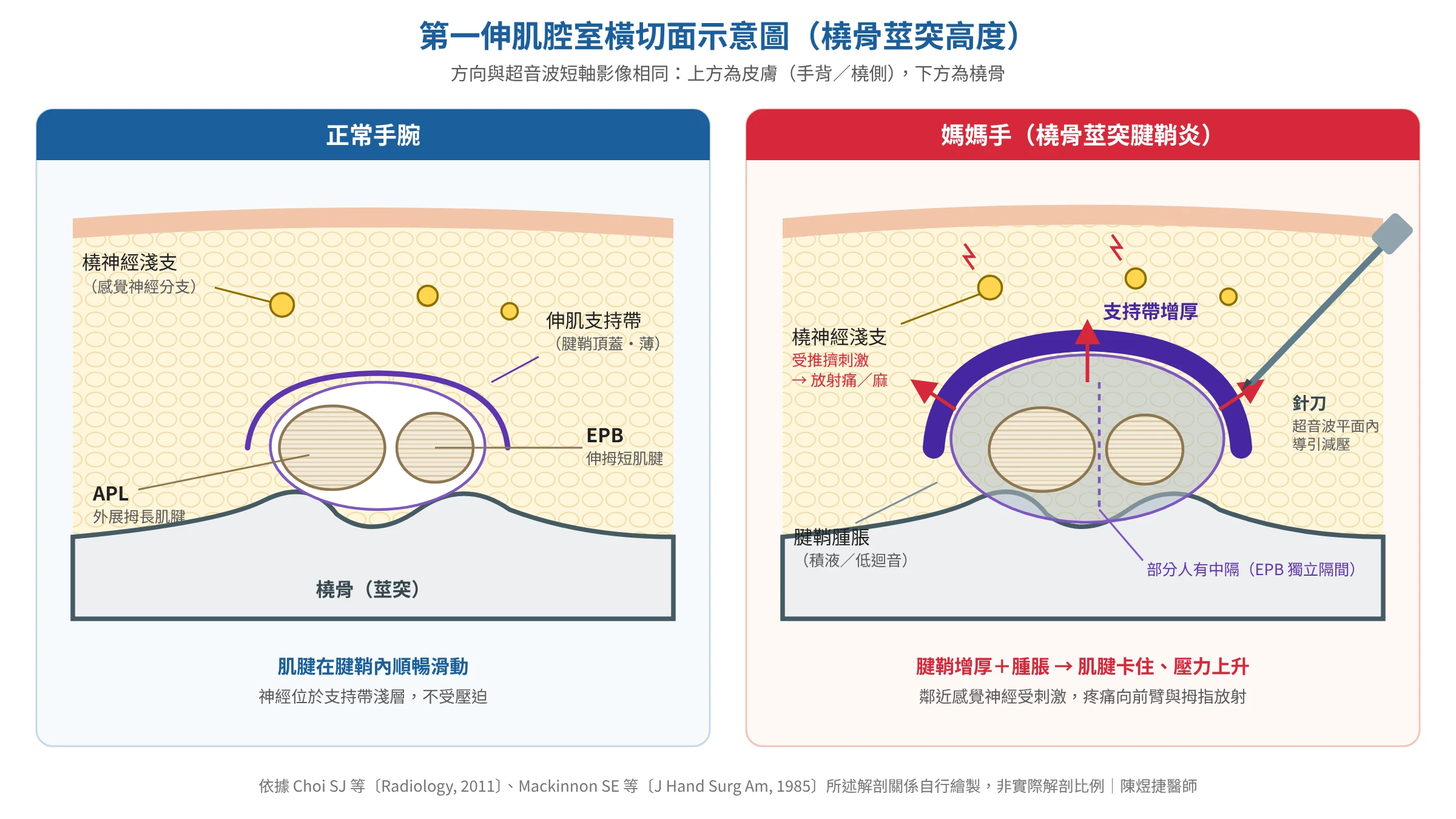 第一伸肌腔室橫切面示意圖