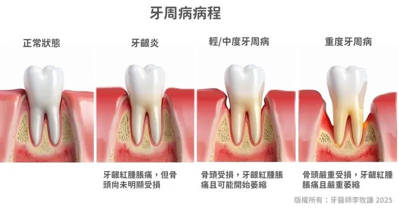 牙周病治療